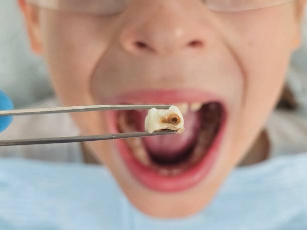 Best Emergency Treatment for Dental Infections or Abscesses in Mulvane, KS